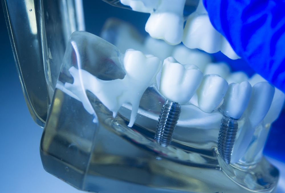 インプラント治療とは