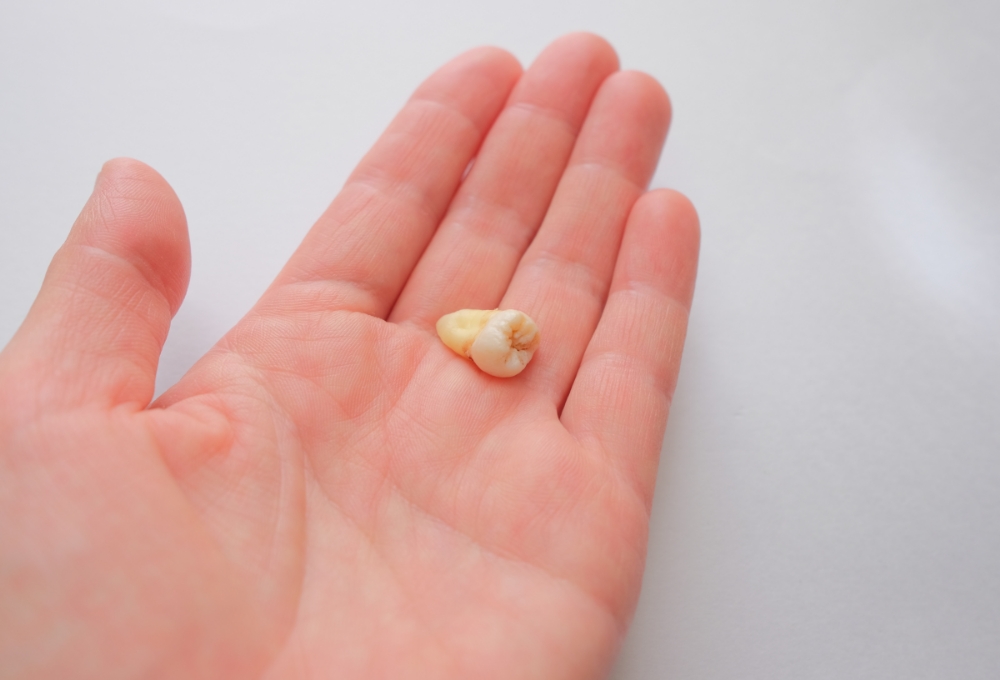 親知らずの抜歯