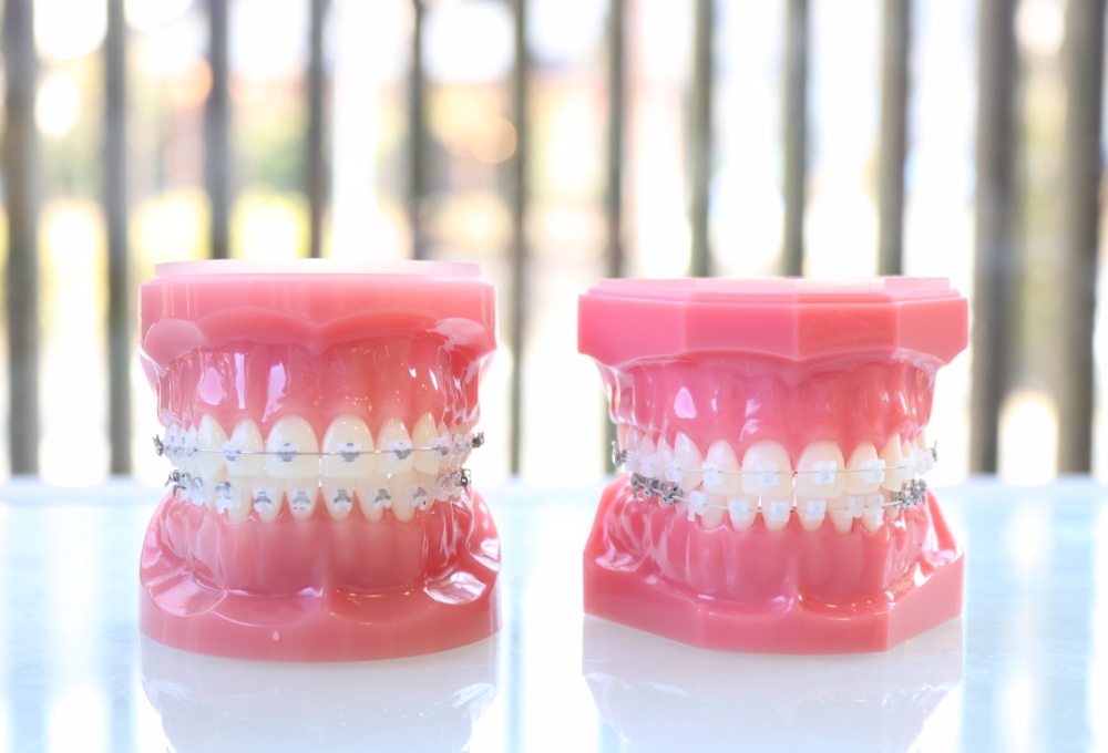 ワイヤー矯正（マルチブラケット装置）